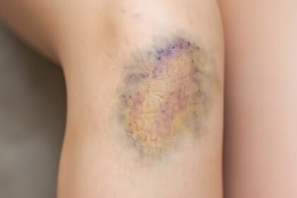 Μελανιές - Πώς φεύγουν οι μελανιές από το δέρμα: 8 φυσικοί τρόποι