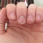 221 - Τι σημαίνουν τα λευκά σημάδια στα νύχια σου και πότε πρέπει να ανησυχείς