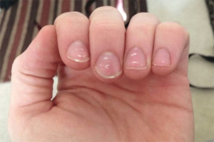 221 - Τι σημαίνουν τα λευκά σημάδια στα νύχια σου και πότε πρέπει να ανησυχείς