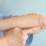 Whisk 4f37aef151502bebaa147680755d4a12dr - Δεν φαντάζεστε τι προκαλεί την ψωρίαση – Το σώμα αντιδρά σε χρόνο-ρεκόρ!