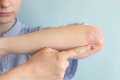 Whisk 4f37aef151502bebaa147680755d4a12dr - Δεν φαντάζεστε τι προκαλεί την ψωρίαση – Το σώμα αντιδρά σε χρόνο-ρεκόρ!