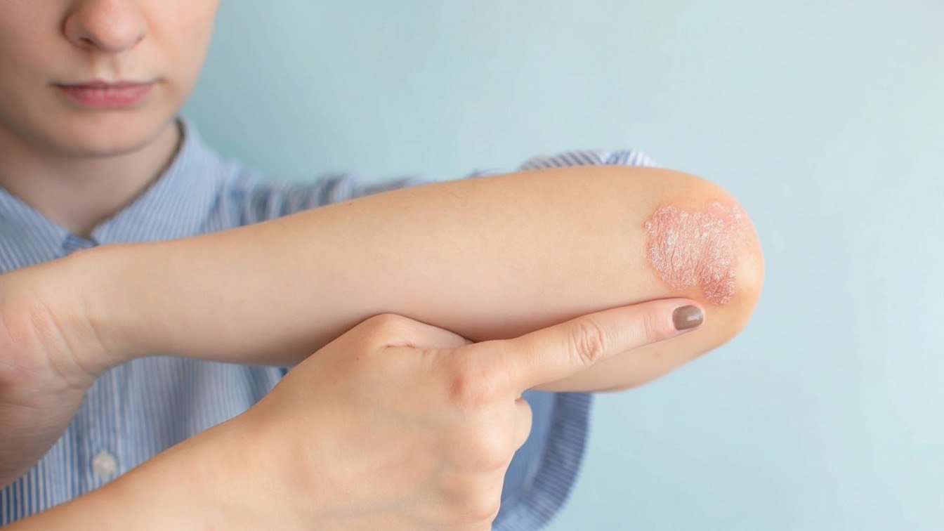 Whisk 4f37aef151502bebaa147680755d4a12dr - Δεν φαντάζεστε τι προκαλεί την ψωρίαση – Το σώμα αντιδρά σε χρόνο-ρεκόρ!