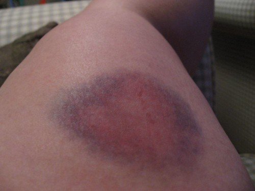 Bruise