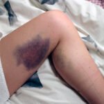 Lucie's bruise after I fell on her