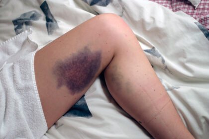 Lucie's bruise after I fell on her